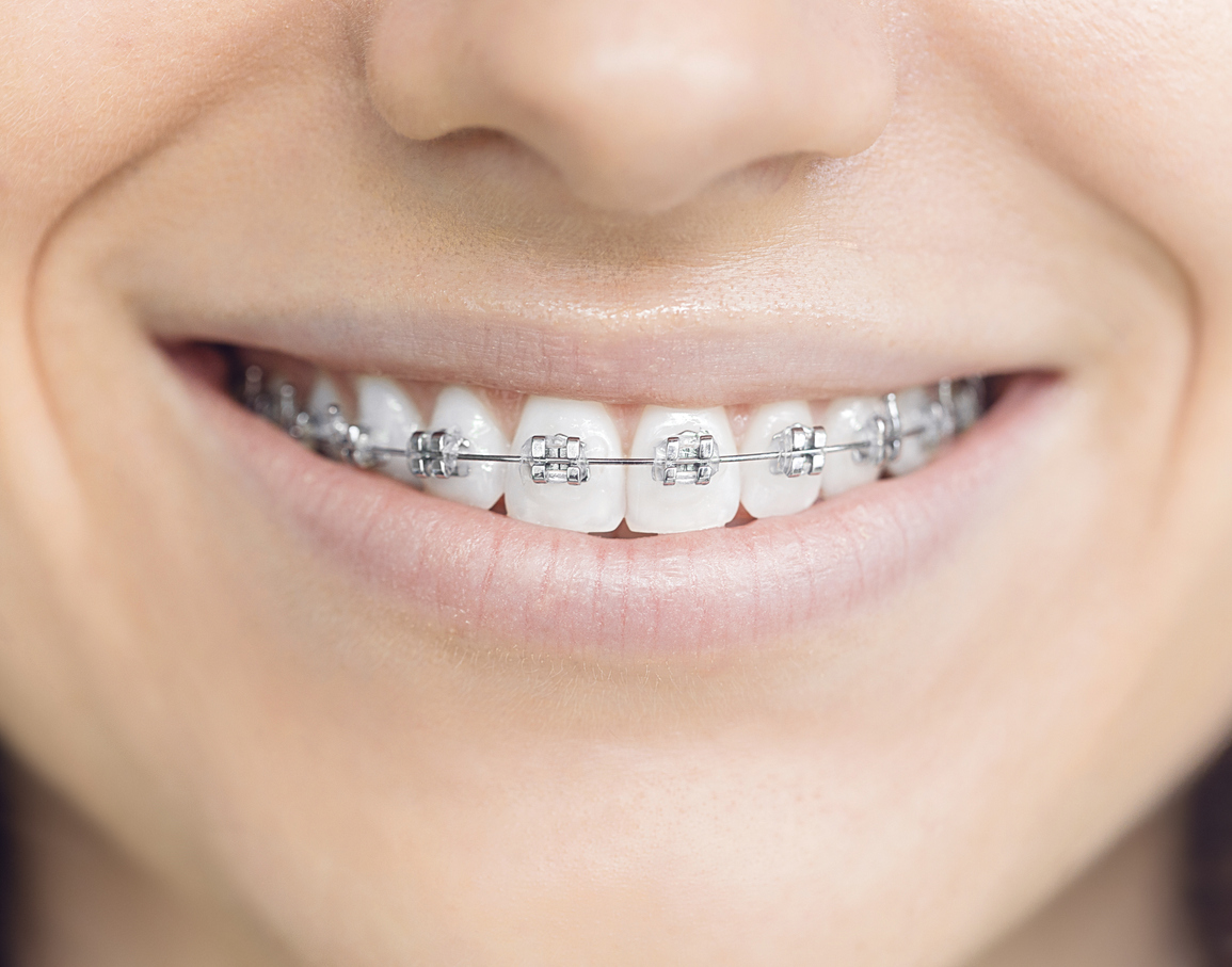 Orthodontic Treatment and Evaluations - Govani Dental